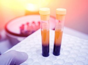 4 remedier for å øke blodplatenivået ditt