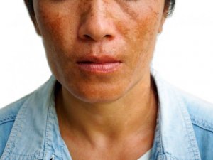 3 behandlinger for å redusere melasma-flekker