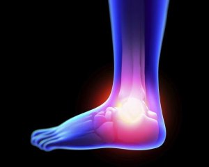 Lær hvordan du kan lege en forstuing på en naturlig måte