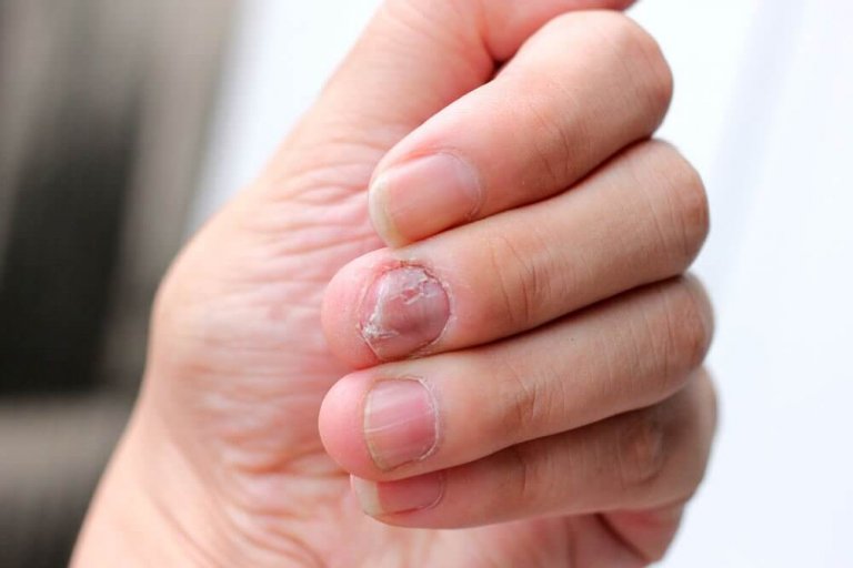 5 naturlige preparater mot psoriasis på neglene