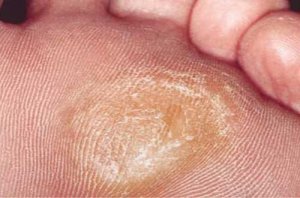 5 naturlige remedier for å mykgjøre træler