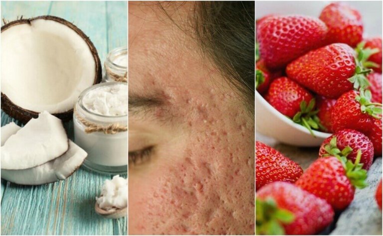 5 hjemmelagde behandlinger for å redusere akne-arr