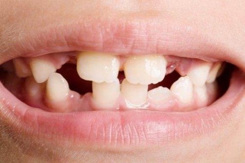 Tannagenesi: Typer og behandlinger