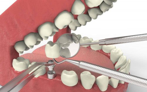 Tannimplantater for å behandle tannagenesi
