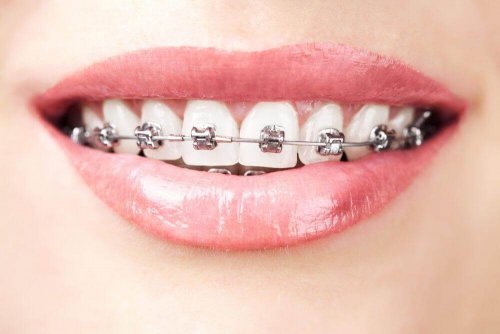 Kvinne med tannregulering