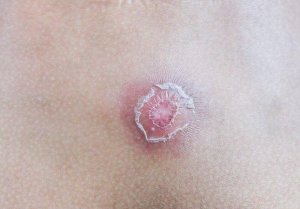 Årsaker til at byller oppstår og 7 tips for å bli kvitt dem