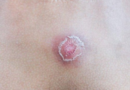 Årsaker til at byller oppstår og 7 tips for å bli kvitt dem