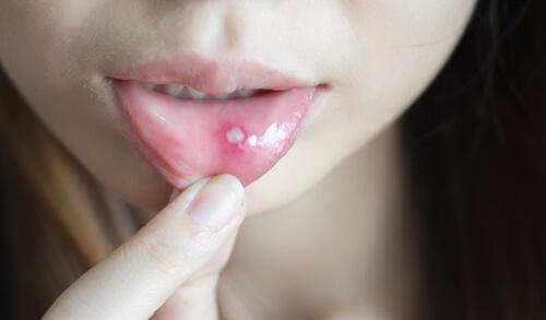 Råd for å kurere munnskåld og munnsår