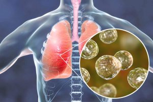 5 naturlige behandlinger mot symptomene ved blastomykose
