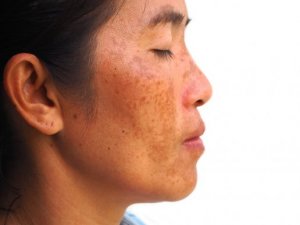 Behandle melasma med yoghurt, bananer og sitroner