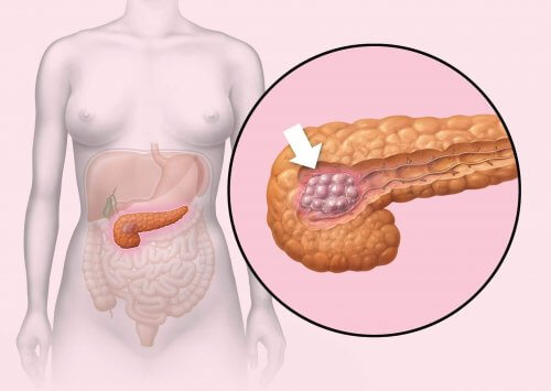 De første hormonelle symptomene på bukspyttkjertelkreft