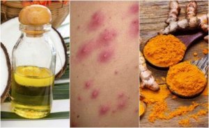 Betennelse i hårsekkene: 5 hjemmeremedier