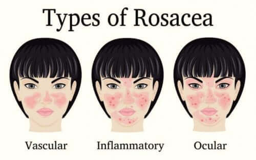 de forskjellige typene rosacea
