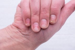 Tre naturlige midler mot gule negler