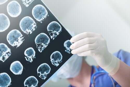 Demens og Alzheimers finnes i hjernen, men i forskjellige områder.