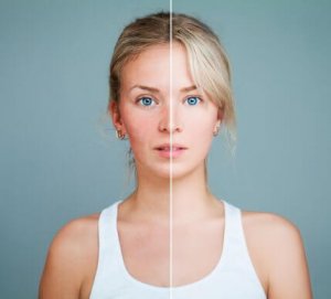 Spis disse 7 matvarene for å forbedre rosacea