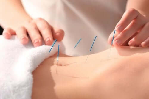 Akupunktur bidrar til å redusere smerte