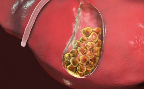 Dersom du lider av gallestein, bør du revurdere kostholdet ditt.