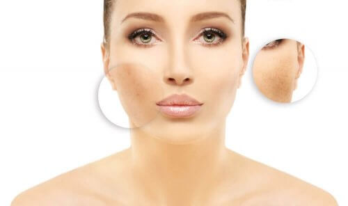 Det finnes behandlinger for pigmentflekker i ansiktet.