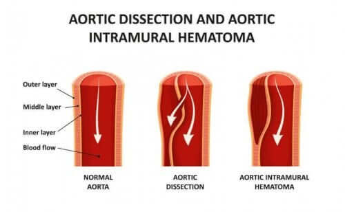 aortadisseksjon arteriekar