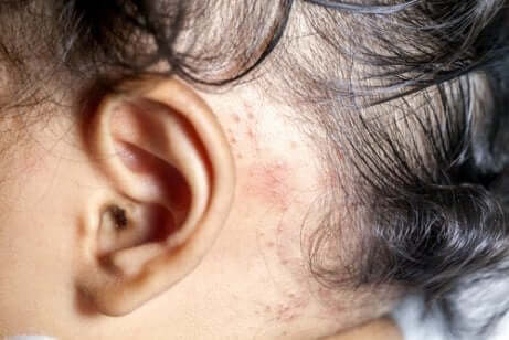 En baby med psoriasis.