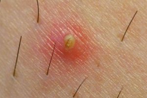 Slik kan du unngå inngrodde hår