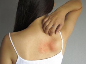 5 topiske behandlinger for å lindre utslett