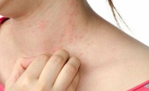 Lindre elveblest med disse naturlige metodene