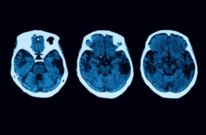 Posterior kortikal atrofi – diagnose og behandling