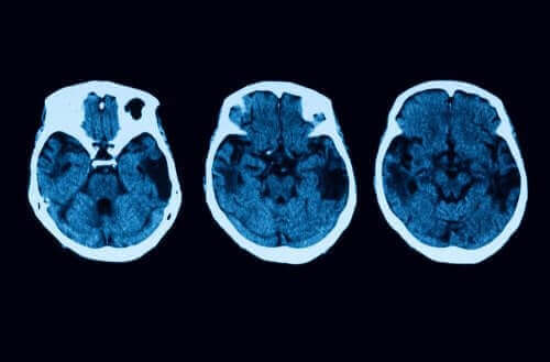 Posterior kortikal atrofi – diagnose og behandling