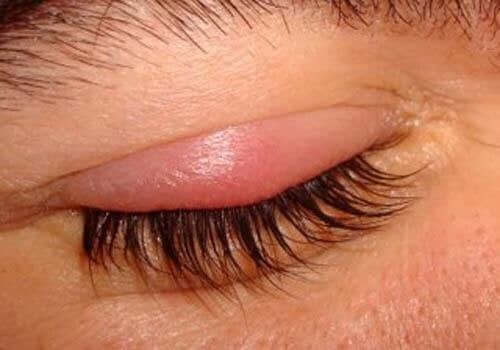 Midd eller lus kan forårsake øyelokksbetennelse