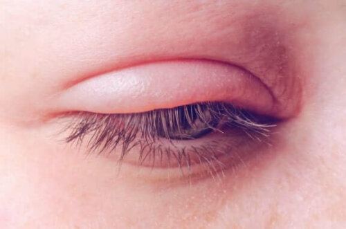 Øyelokksbetennelse: årsaker, symptomer og behandling