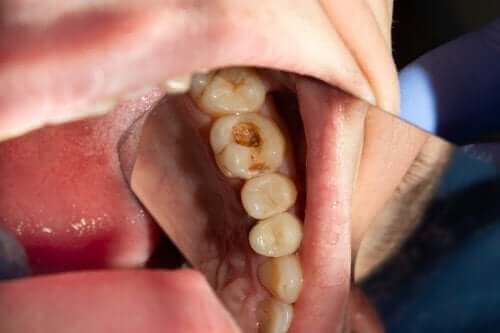 Tannråte: Hva er det som forårsaker hull i tennene?