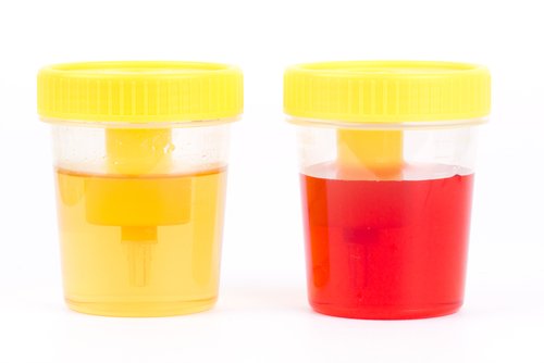 Hematuri (blod i urinen): Symptomer og årsaker