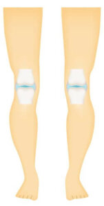 De forskjellige typene av synovialledd