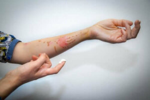 Lær hvordan man behandler overfladiske brannsår