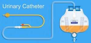 Behandling av urinretensjon etter fødsel