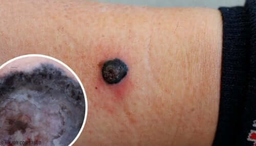 Hva er egentlig en ondartet melanom?