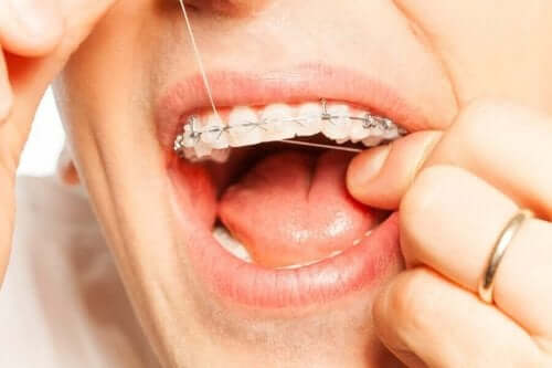 Det er viktig å bruke tanntråd for god tannhygiene med kjeveortopedi. 