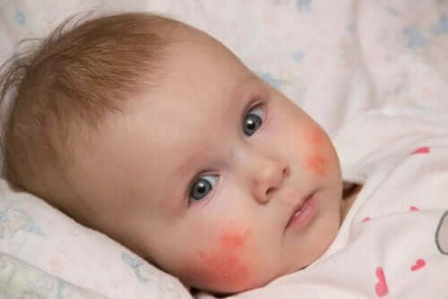 En baby med utslett i ansiktet.