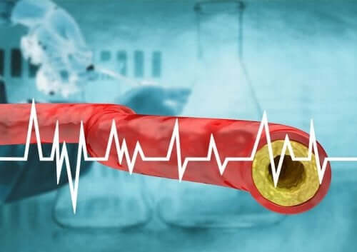 En illustrasjon av høyt kolesterol.