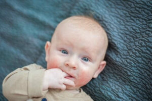 Grunnleggende pleie for atopisk dermatitt hos babyer