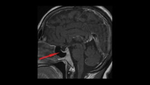 Hva er egentlig et hypofyseadenom?