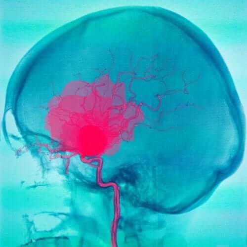 Hjernehinneblødning og subduralt hematom