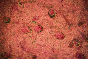 Sykdommen nyretuberkulose: Diagnose og behandling