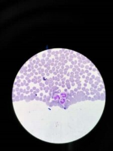 Behandlinger for sykdommen agranulocytose