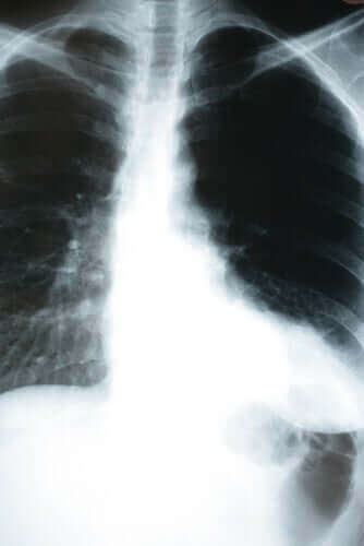Lær hvordan kroppen påvirkes av lungebetennelse