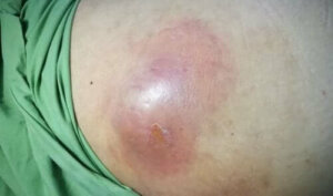 Hva er intraabdominale abscesser?