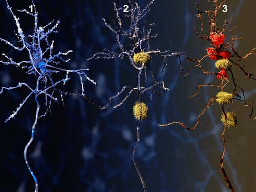 Illustrasjon av fasene av Alzheimers og virkningene av donepezilhydroklorid.