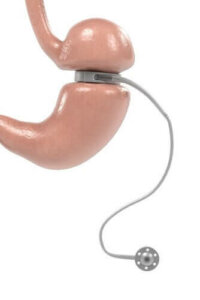 Justerbart gastrisk bånd – bruk og kjennetegn